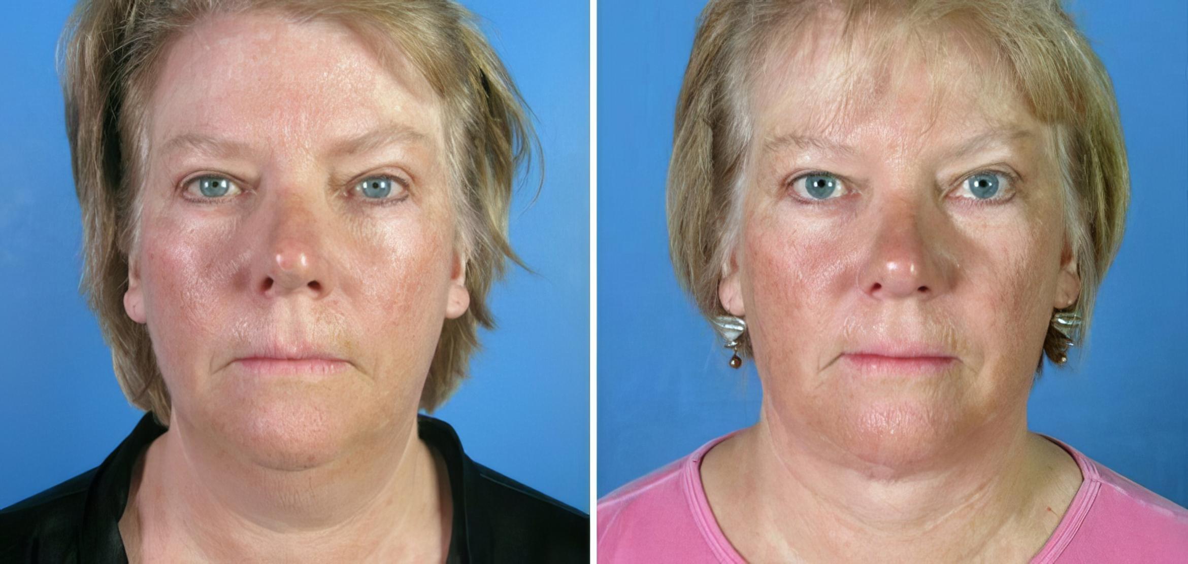 Facelift Before & After Case 17717