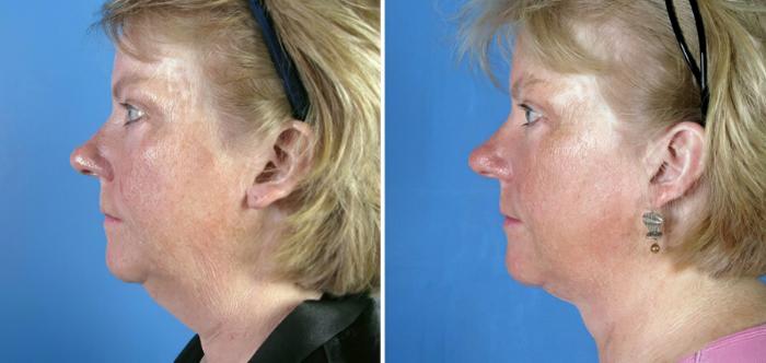 Facelift Before & After Case 17717