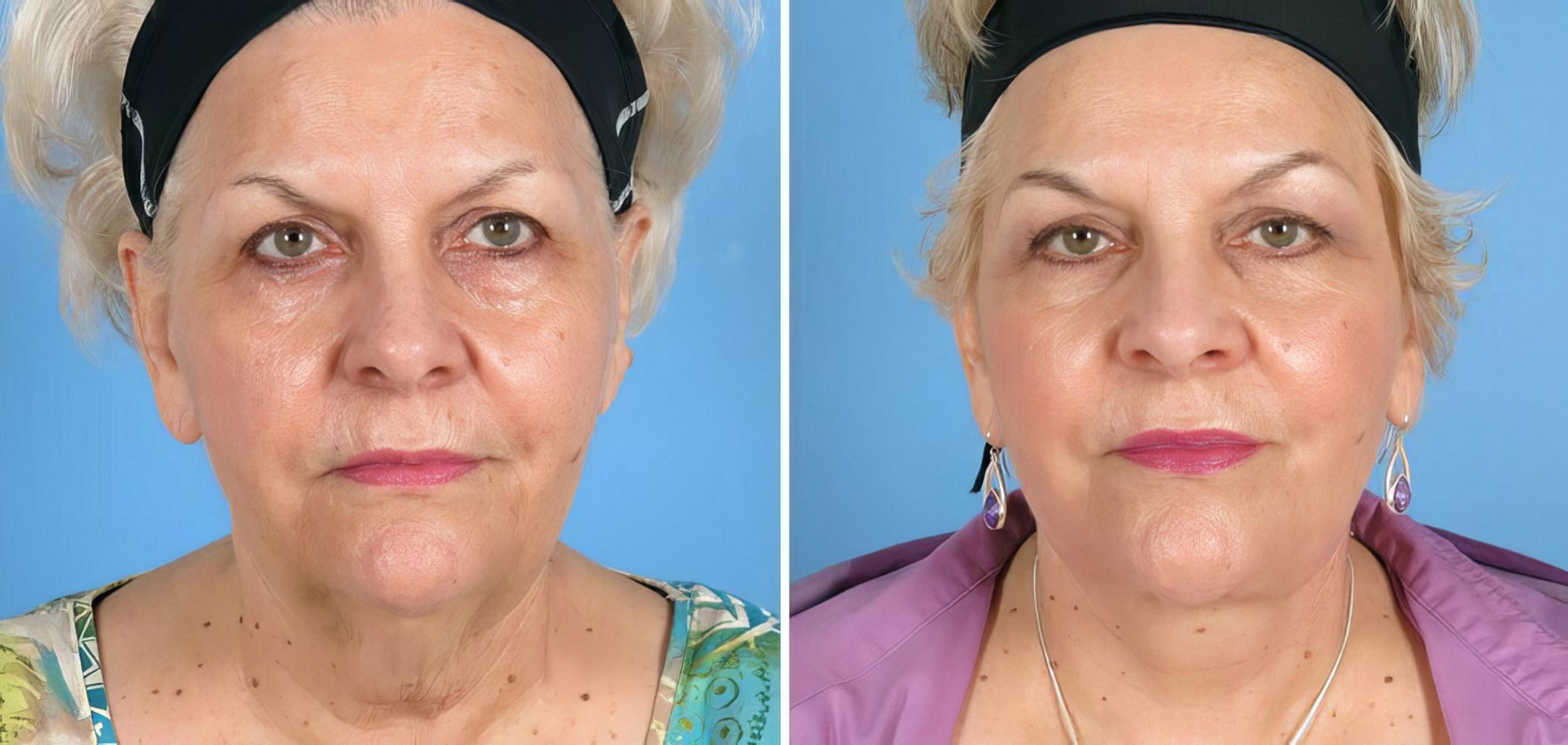 Facelift Before & After Case 17720