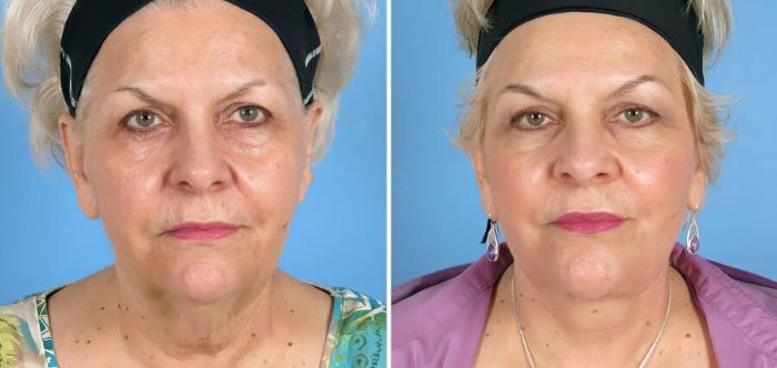 Facelift Before & After Case 17720