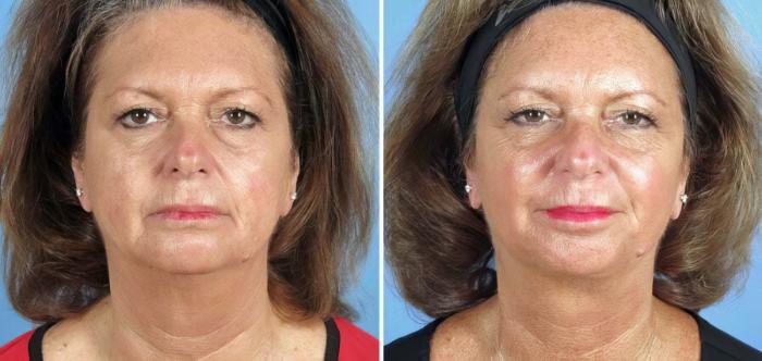 Facelift Before & After Case 17723