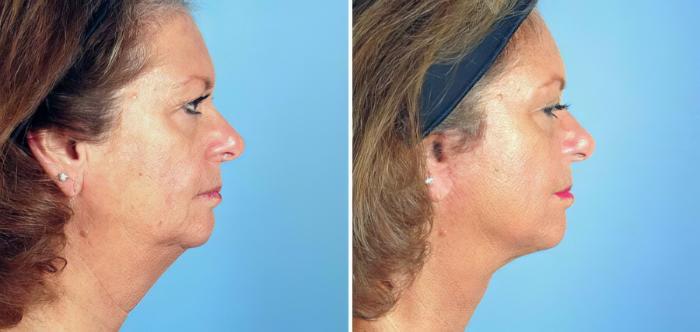 Facelift Before & After Case 17723