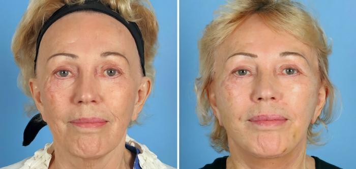 Facelift Before & After Case 17726
