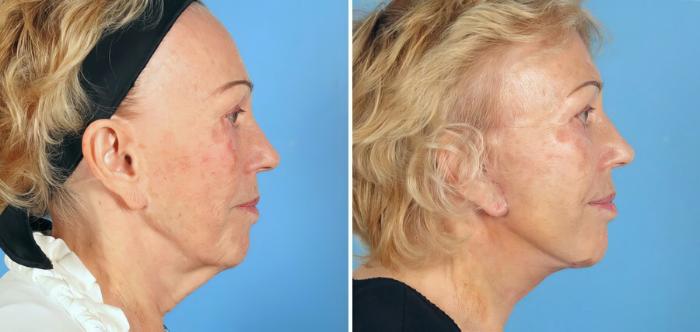 Facelift Before & After Case 17726