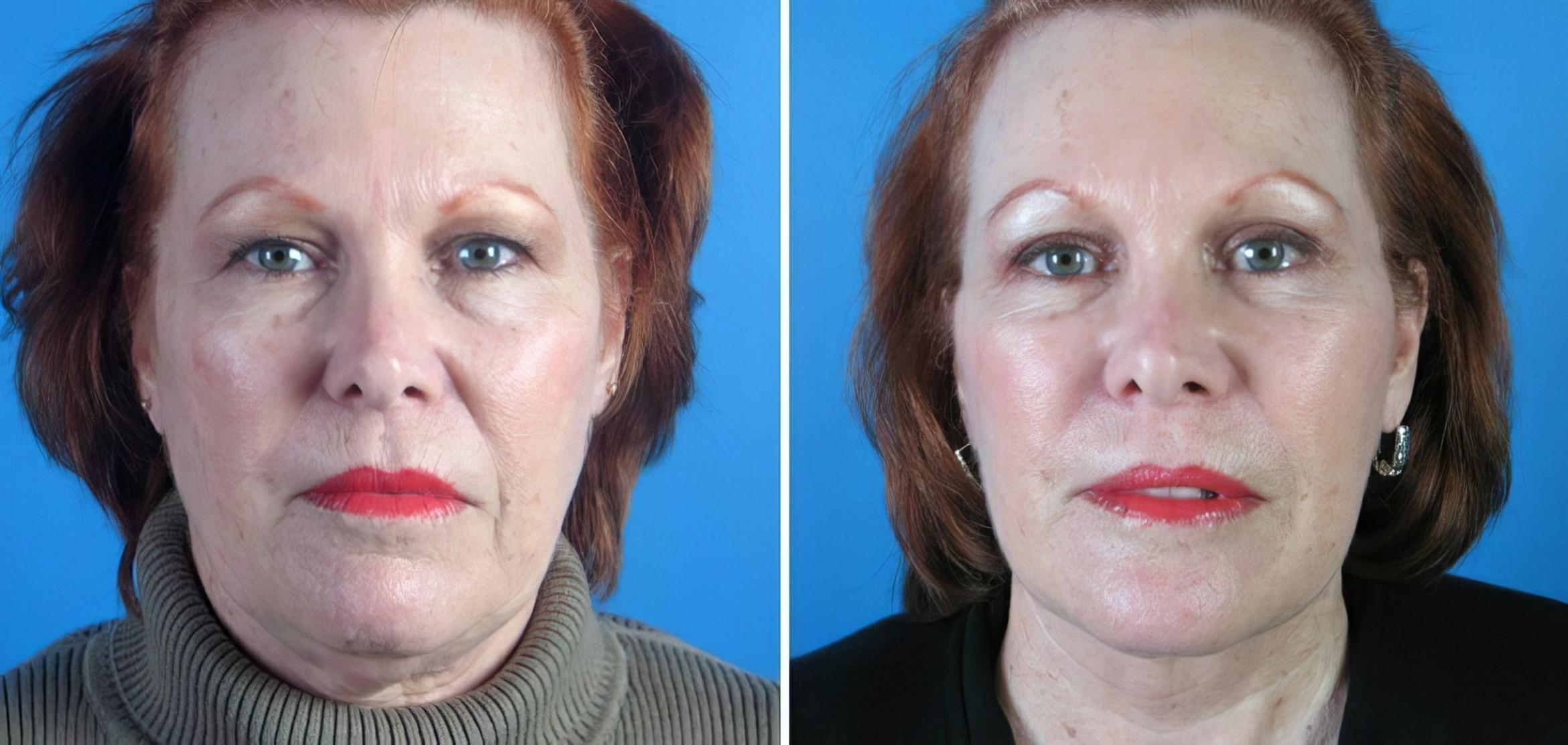 Facelift Before & After Case 17729