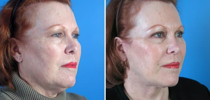Facelift Before & After Case 17729