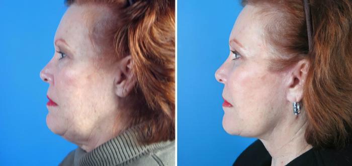 Facelift Before & After Case 17729