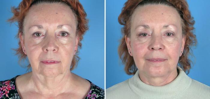 Facelift Before & After Case 17734