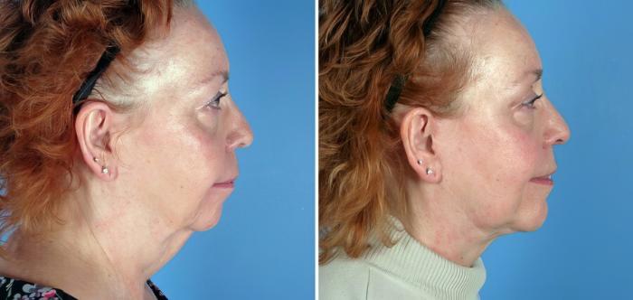 Facelift Before & After Case 17734