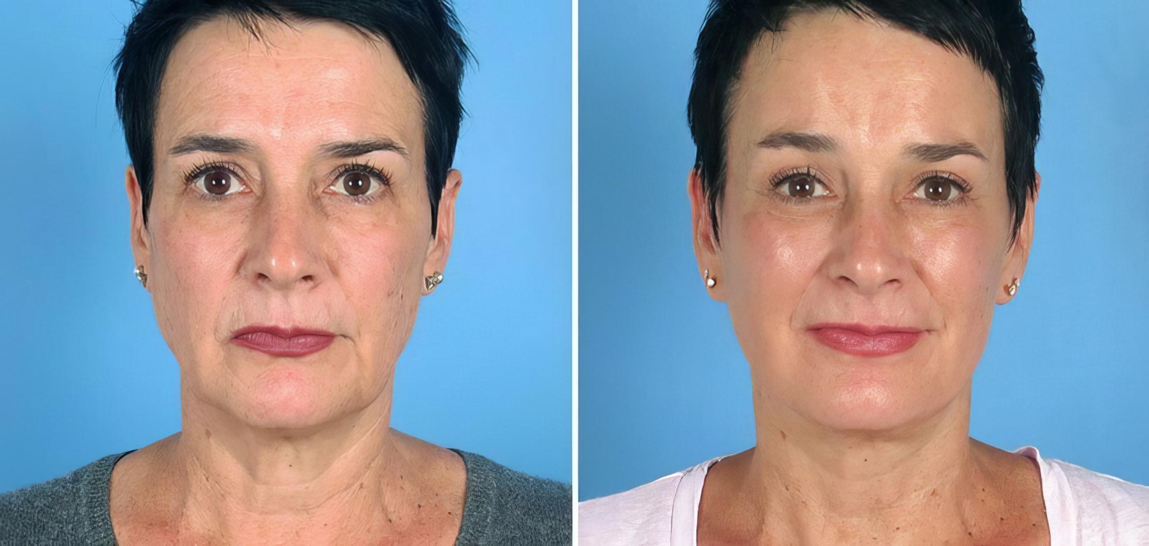 Facelift Before & After Case 19544