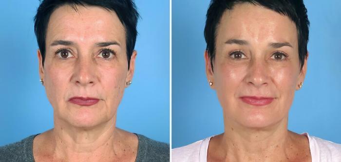 Facelift Before & After Case 19544