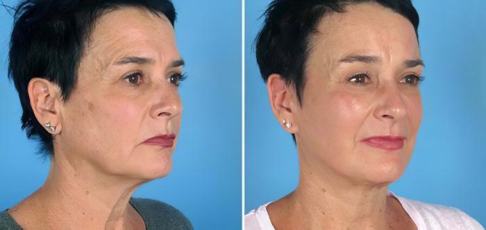 Facelift Before & After Case 19544