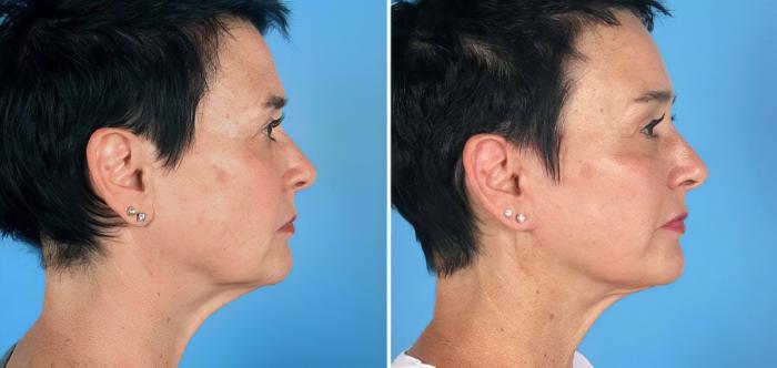 Facelift Before & After Case 19544