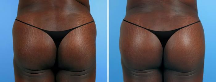 Fat Transfer Before & After Case 19513