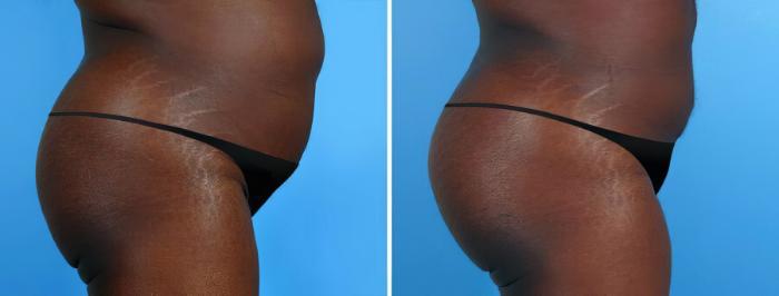 Fat Transfer Before & After Case 19513