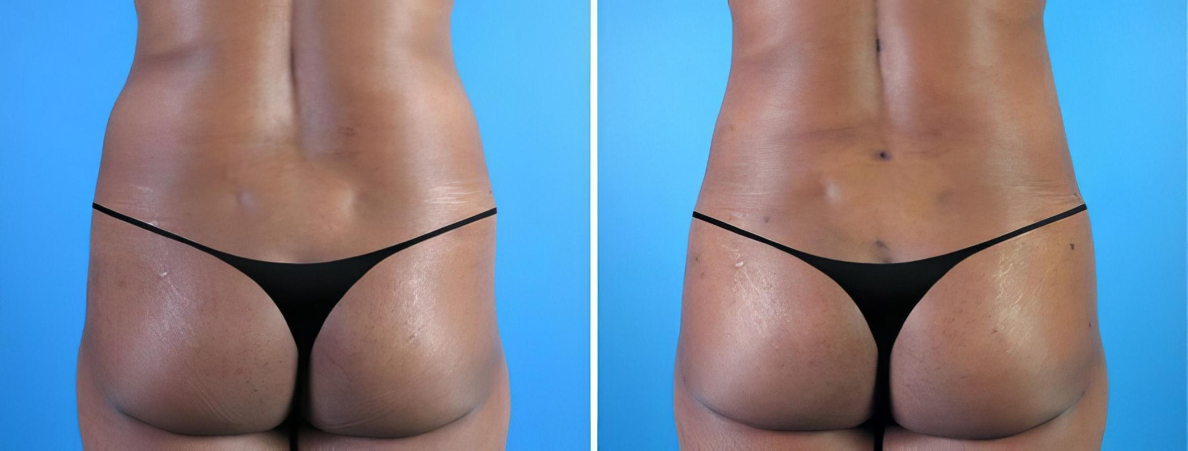 Fat Transfer Before & After Case 19869
