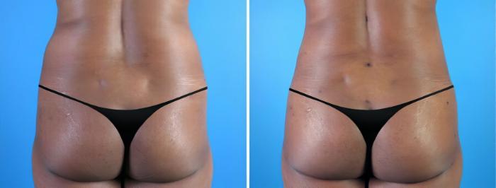 Fat Transfer Before & After Case 19869