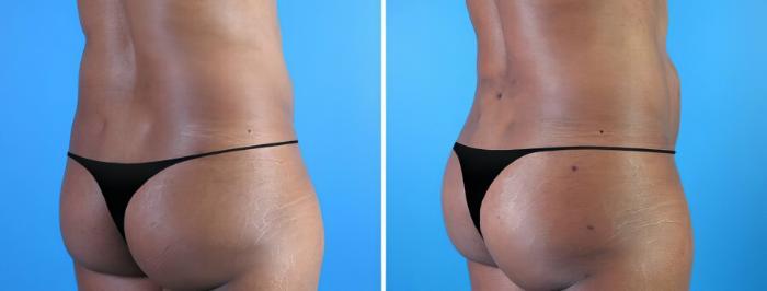 Fat Transfer Before & After Case 19869