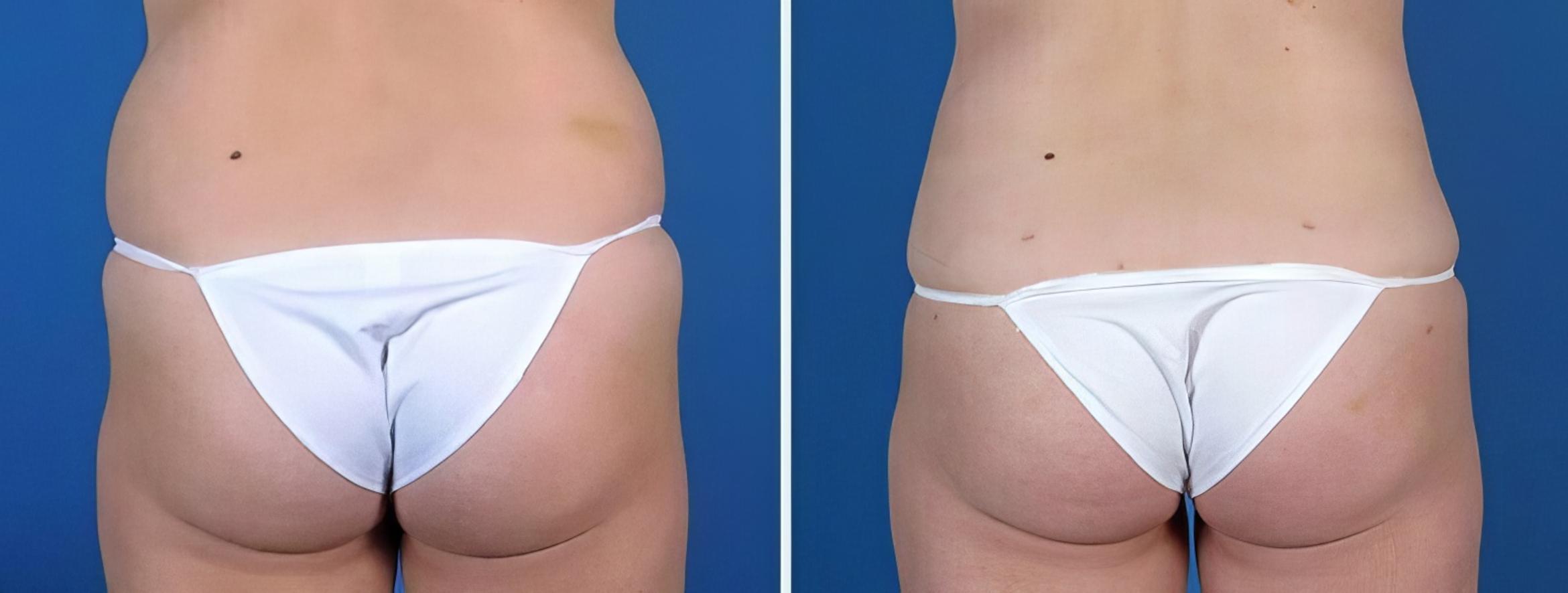 Fat Transfer Before & After Case 25653