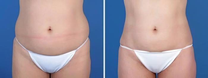 Fat Transfer Before & After Case 25653