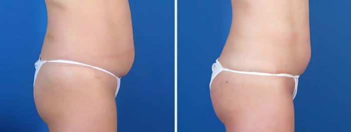Fat Transfer Before & After Case 25653