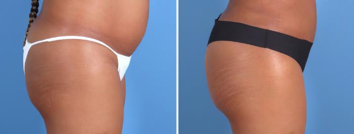 Fat Transfer Before & After Case 26707