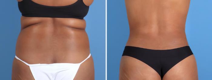 Fat Transfer Before & After Case 26707