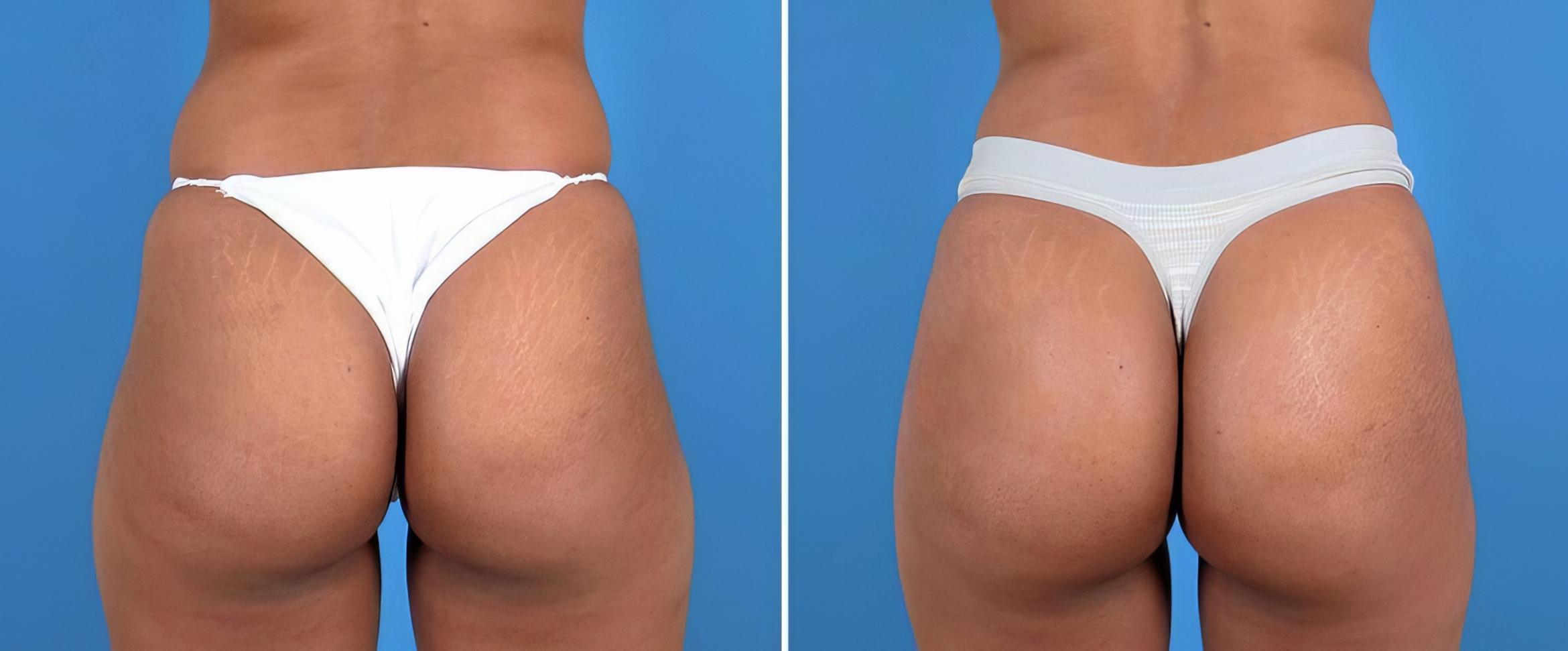 Injectable Butt Lift Before & After Case 25959