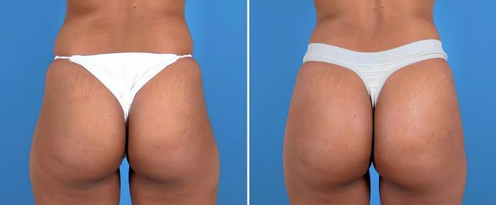 Injectable Butt Lift Before & After Case 25959