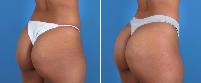 Injectable Butt Lift Before & After Case 25959