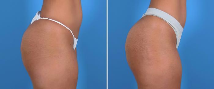 Injectable Butt Lift Before & After Case 25959