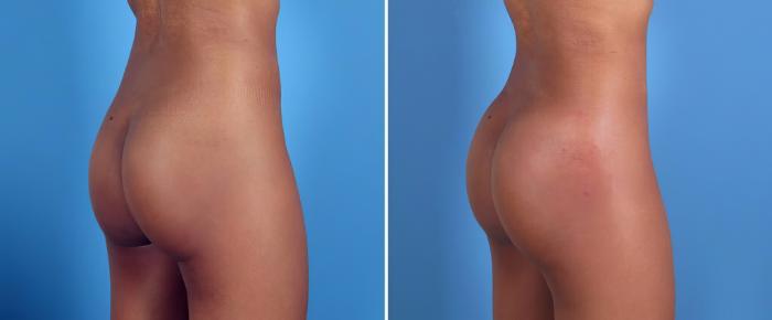 Injectable Butt Lift Before & After Case 26156