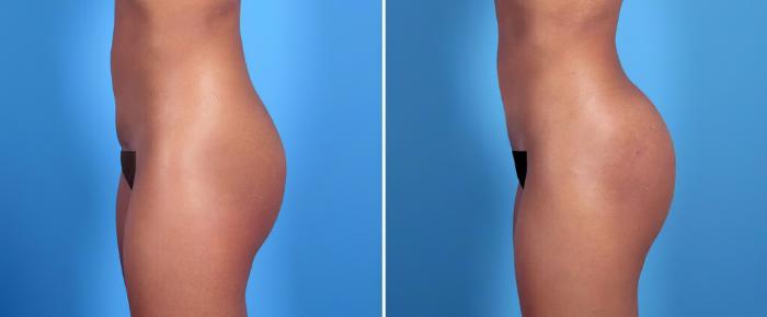 Injectable Butt Lift Before & After Case 26156