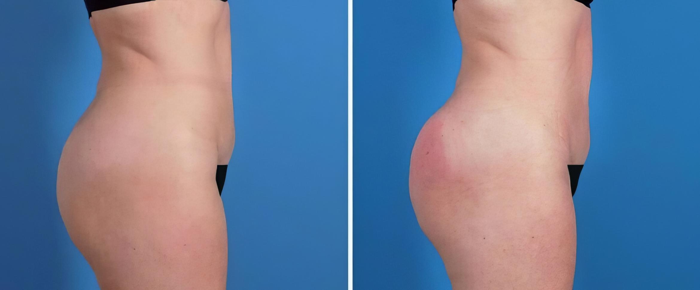 Injectable Butt Lift Before & After Case 26496