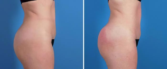 Injectable Butt Lift Before & After Case 26496