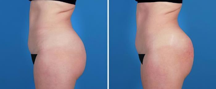 Injectable Butt Lift Before & After Case 26496