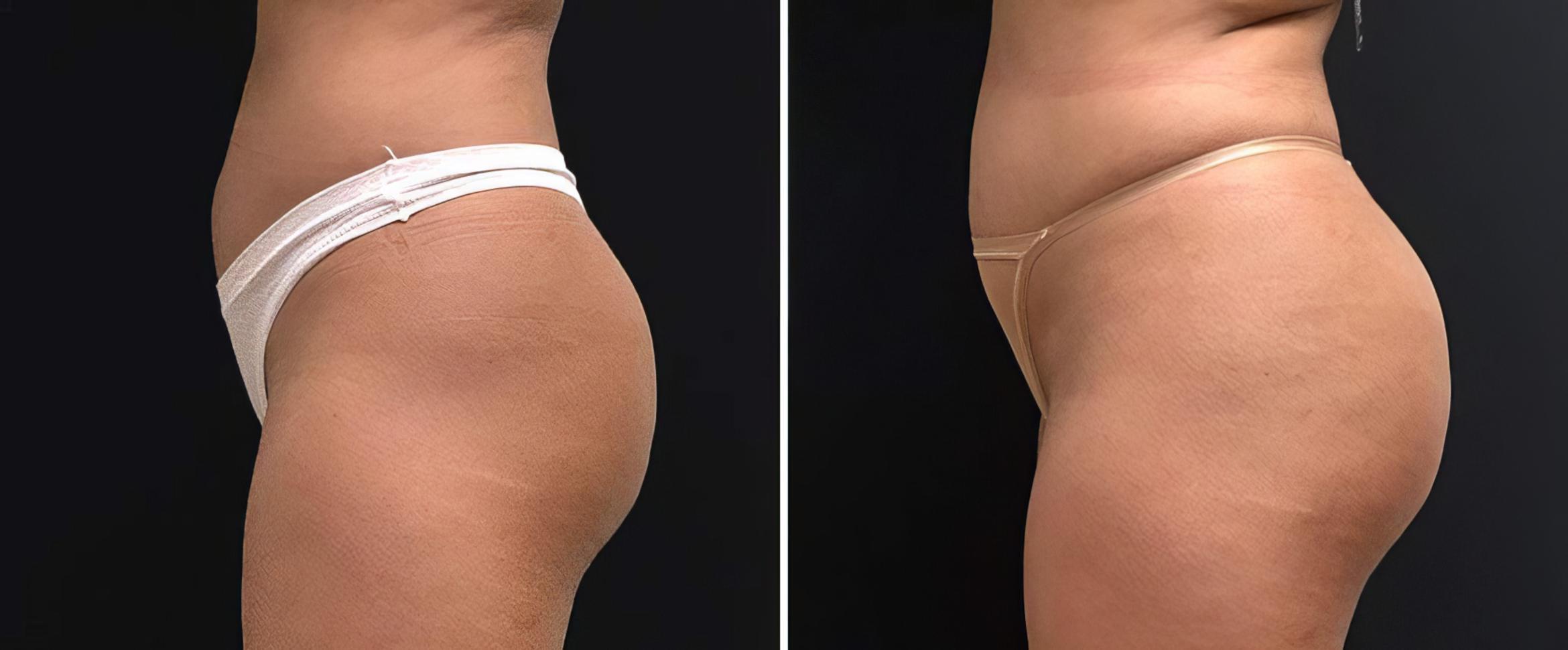 Injectable Butt Lift Before & After Case 26833