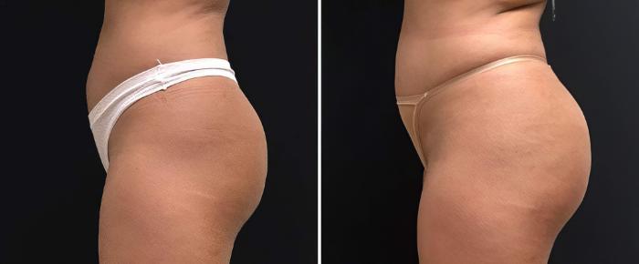 Injectable Butt Lift Before & After Case 26833