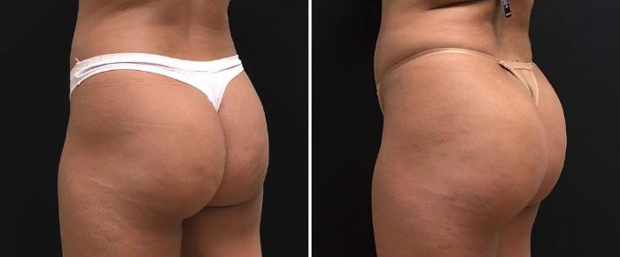 Injectable Butt Lift Before & After Case 26833