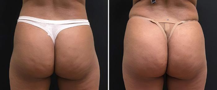 Injectable Butt Lift Before & After Case 26833