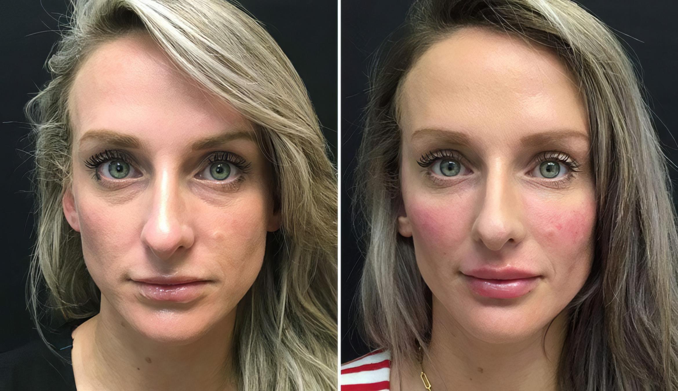 Injectables & Fillers Before & After Case 26623