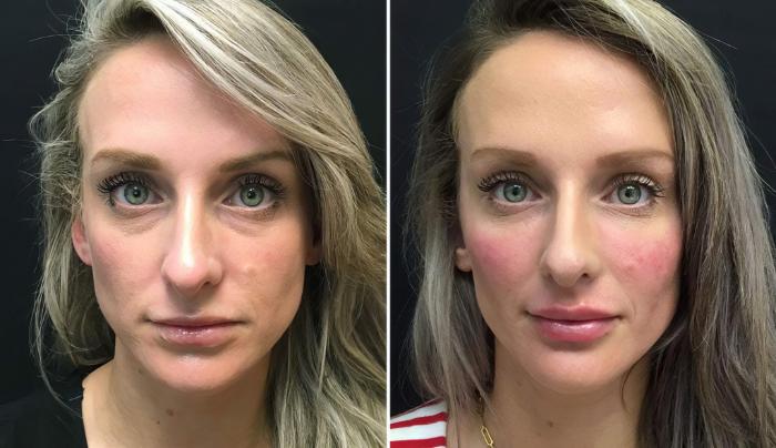 Injectables & Fillers Before & After Case 26623