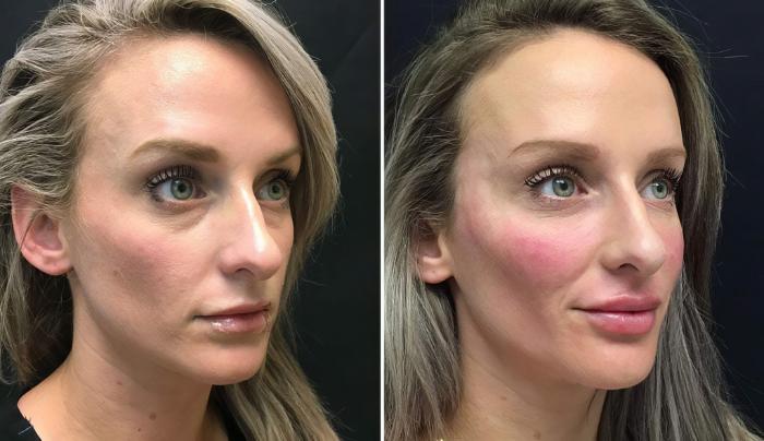 Injectables & Fillers Before & After Case 26623