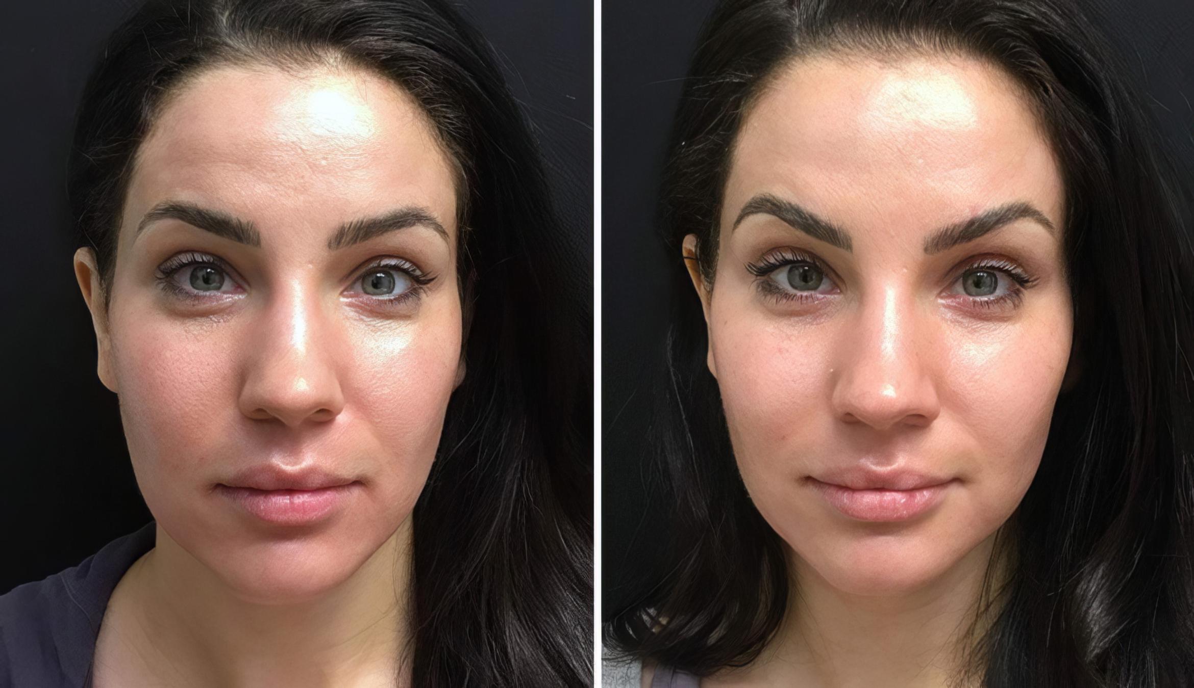 Injectables & Fillers Before & After Case 26626