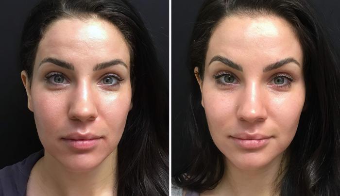 Injectables & Fillers Before & After Case 26626
