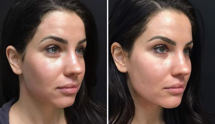 Injectables & Fillers Before & After Case 26626