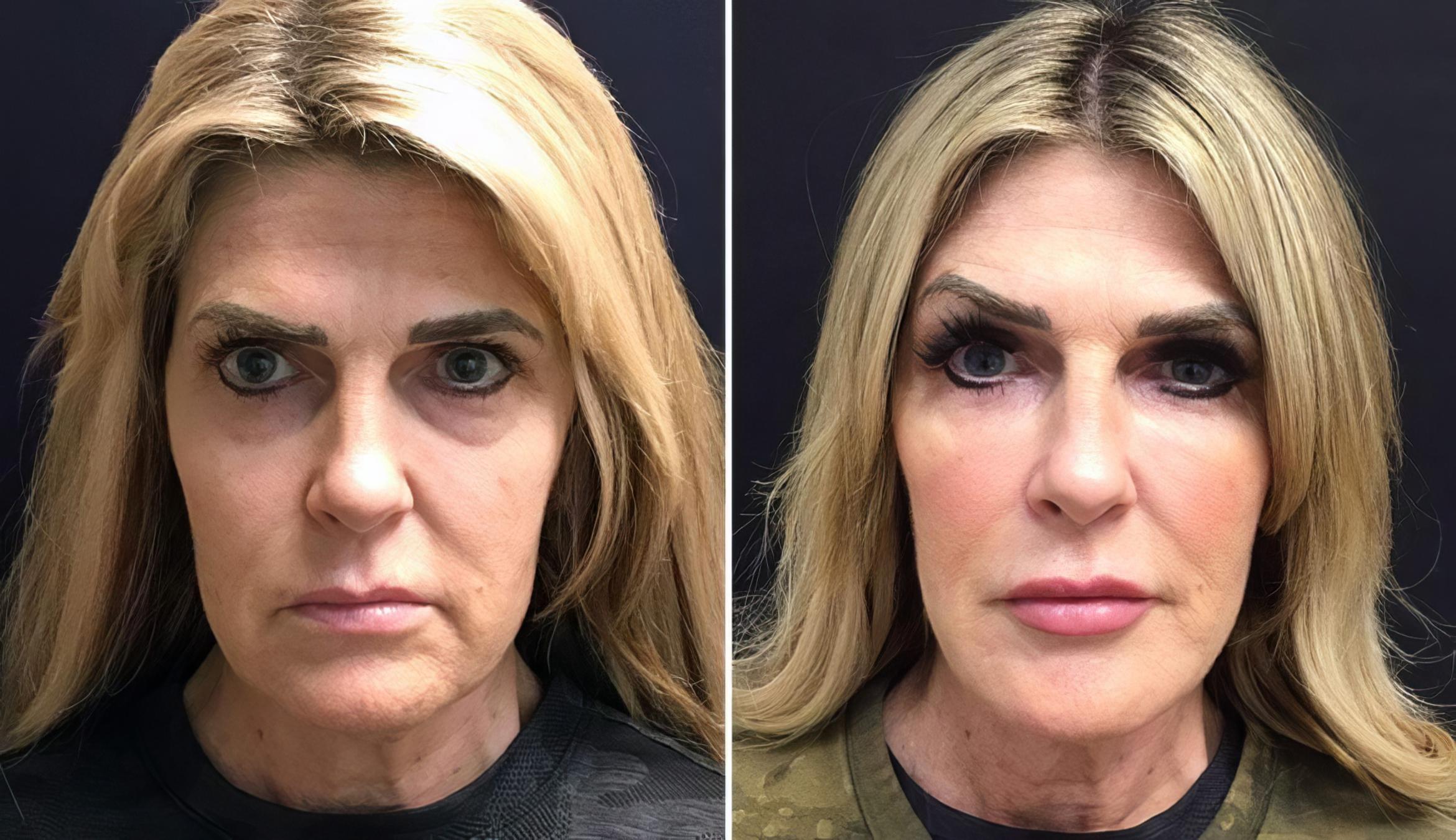 Injectables & Fillers Before & After Case 26630