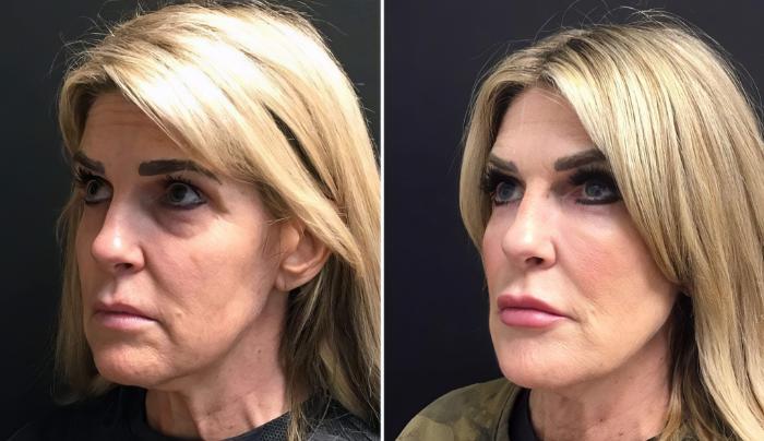 Injectables & Fillers Before & After Case 26630