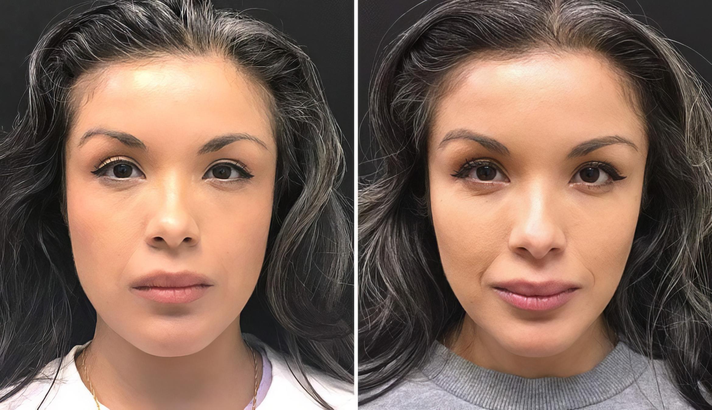 Injectables & Fillers Before & After Case 26633