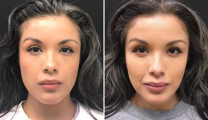 Injectables & Fillers Before & After Case 26633